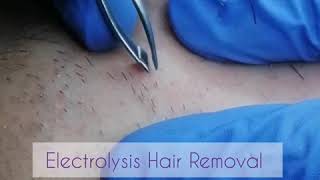 Electrolysis Permanent Hair Removal Face [upl. by Marysa]