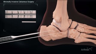 Minimally Invasive Calcaneus Surgery [upl. by Waldo978]