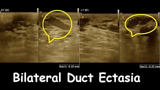 Bilateral duct ectasia  Breast Report  Amader hospital  Ultrasound report format ideas [upl. by Emolas948]