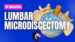 Lumbar Microdiscectomy  3D Animation [upl. by Ursel]