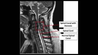 Spinal stenosis [upl. by Ertha]