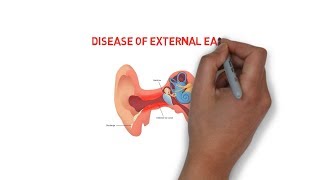 Diseases of external ear  trauma  inflammatory  neoplastic disorders2 [upl. by Hanna162]