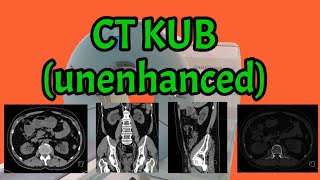 CT KUB Unenhanced [upl. by Davina]