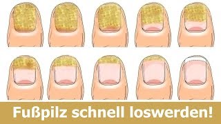 7 Hausmittel mit denen du Nagelpilz in wenigen Tagen loswirst  Ärzte sind erstaunt [upl. by Ykcub162]