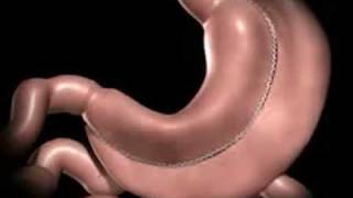 Laparoscopic Vertical Sleeve Gastrectomy by Marc Zare MD [upl. by Adelbert]