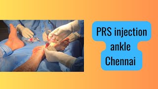 PRP amp PRS injections of ankle joints in Chennai [upl. by Ranjiv391]