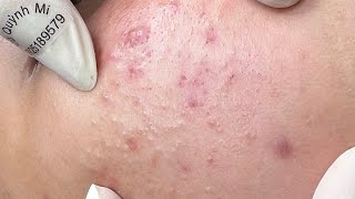 ACNE TREATMENT VU QUYNH MI Acne On Boys Chin 2024 [upl. by Millda]