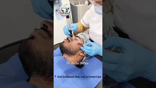 Treatment for acne pits and scarsmicro needling therapy skincare shorts viral drrichadubey [upl. by Elsa860]