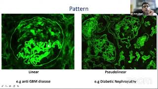 Dr Alok Sharma  Interpretation of Immunofluorescence and Electron Microscopy in Renal Biopsies [upl. by Nedarb]