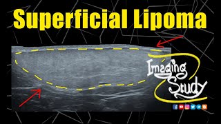 Superficial Lipoma  Ultrasound  Case 325 [upl. by Tichon296]