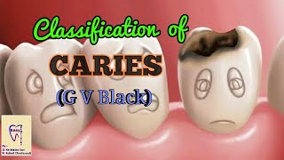 Dental Caries  Classification of dental caries  GV Black Classification [upl. by Anoo]