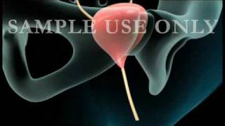 Cystoscopy  Medical Animationflv [upl. by Filberto]