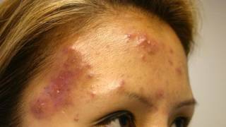 The Acne Practice severe case 5 [upl. by Ycul]