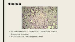 27MIOMATOSIS UTERINA●DRDUEÑAS [upl. by Akilak]