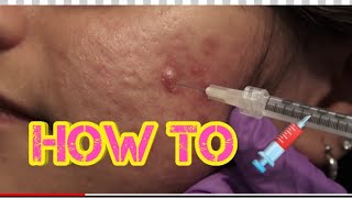 Watch and Learn intralesional injection 💉 [upl. by Kannav485]