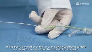 Demonstration of EmboCatcher™ Embolic Protection Device [upl. by Ecnaiva]