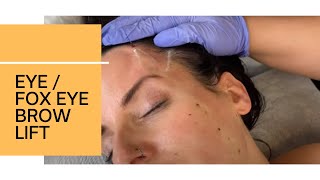 SNATCHED CAT EYE  FOX EYE BROW LIFT IN SECONDS USING PDO MIRACU ELASTY THREADS  DR JASON EMER [upl. by Ivets]