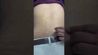 Dryneedling therapy for back pain dryneedling ytshorts backpain physiotheraphy terenaina [upl. by Butte]