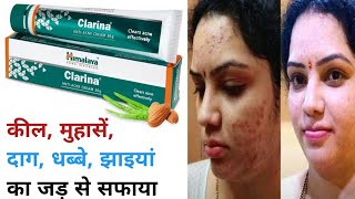 Himalaya Clarina Antiacne Cream Review  Kaise use kare  Results  Acne Removal Cream [upl. by Chud]