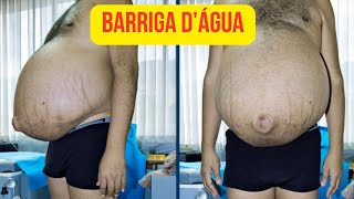 Barriga dágua  Esquistossomose [upl. by Jobey]