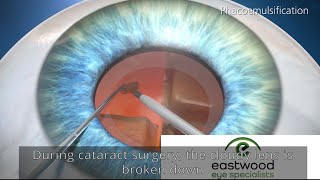 What is involved with Cataract Surgery Explained by Sydney eye surgeon [upl. by Leunamme]