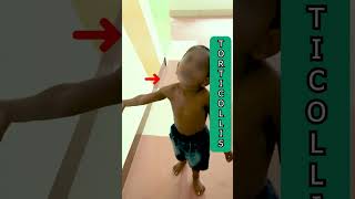 Torticollis The Neck Syndrome That Changes Lives shorts Dr Girish senior physiotherapist [upl. by Annoyed240]