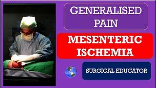 MESENTERIC ISCHEMIA How To DIAGNOSE amp TREAT GENERALISED ABDOMINAL PAIN [upl. by Alvis]