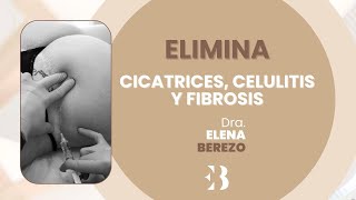 Elimina cicatrices celulitis y fibrosis  Clínicas EB [upl. by Oiziruam]