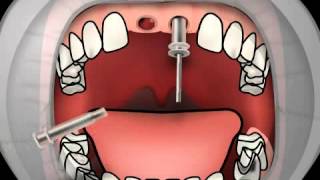 Impression Post in oral Implantology [upl. by Darrill]