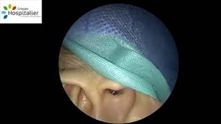 Endoscopic Myringotomy and Ventilation Tube Insertion [upl. by Skvorak]