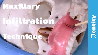 Maxillary Infiltration Technique  شرح عملي [upl. by Terr]