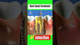 Root Canal Treatment Infected Tooth Apex [upl. by Sexton683]