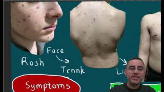 Chickenpox  Signs Symptoms Treatment How long does chicken pox last [upl. by Undine]