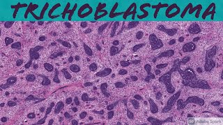 Trichoblastoma 5Minute Pathology Pearls [upl. by Nonrev]