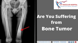 Osteoid Osteoma Treatment in Hyderabad  Thermal Ablation of Bone Tumour  Official Video [upl. by Adnirual493]