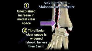 Ankle Fracture Maisonneuve Fracture  Everything You Need To Know  Dr Nabil Ebraheim [upl. by Enomar]