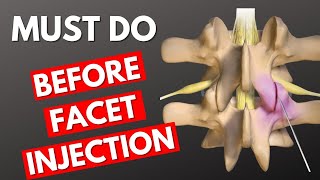 Before Facet Injection Do This  Lumbar Facet Injection [upl. by Errehs499]