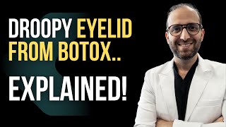 Botox Gone Wrong  Explained [upl. by Eninej]