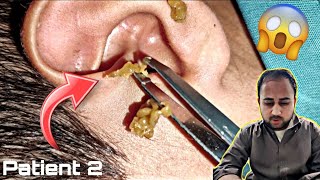 Ear Cleaning Opened Full ear infection  Ear wax Removal Part 2 [upl. by Harri]