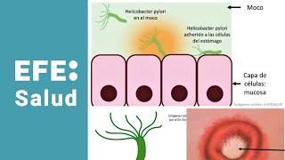 Helicobacter pylori protagonista del cáncer de estómago [upl. by Greysun]