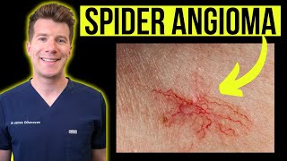 Doctor explains SPIDER ANGIOMA aka spider nevustelangiectasia  Causes photos treatments [upl. by Matazzoni6]