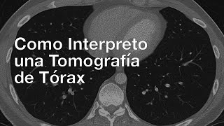 Como Interpreto una Tomografía de Tórax [upl. by Zigmund]