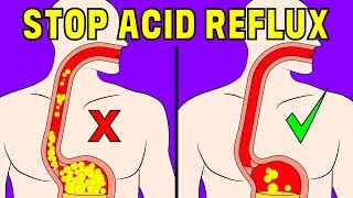 The 4 minute natural trick to prevent acid reflux in the oesophagus [upl. by Bonucci]