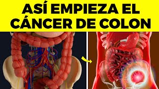 Las 10 PRIMERAS SEÑALES de CÁNCER DE COLON que nunca debes ignorar [upl. by Namzaj996]