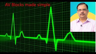 Understanding AV blocks  ECG made simple  medicine concepts [upl. by Georgina]