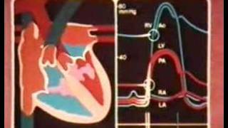 18  Transposition der großen Arterien [upl. by Noslien]