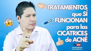 TRATAMIENTOS QUE SÍ FUNCIONAN EN CICATRICES DE ACNÉ [upl. by Adleremse]