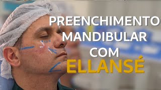 Dra Carla ScanaviniTécnica de preenchimento mandibular com Ellansé [upl. by Claman970]