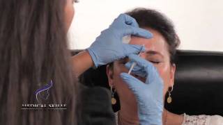 Botulinum Toxin  Injection Technique [upl. by Edouard]