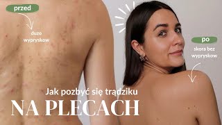 Jak pozbyć się trądziku na plecach 🧖🏼‍♀️ ✨ łatwe i skuteczne sposoby na bacne [upl. by Corwin]